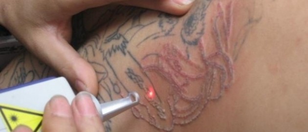 Eliminacion tatuajes por laser en Nave Rock